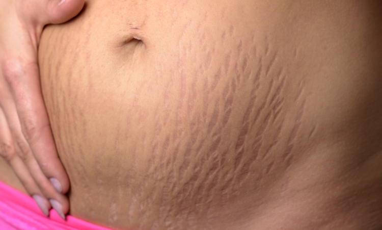 Ciało po porodzie – kobieta wskazująca rozstępy na brzuchu.